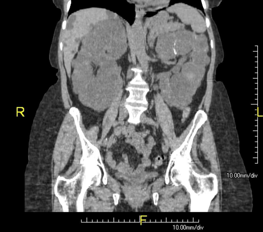 Polycystic Kidneys (ADPKD) and Liver Cysts. CT coronal view of abdomen.