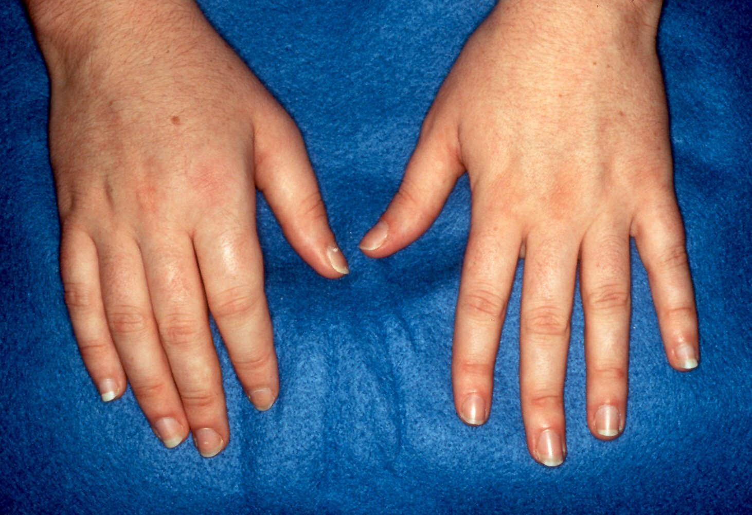 Oligoarticular Arthritis in PsA