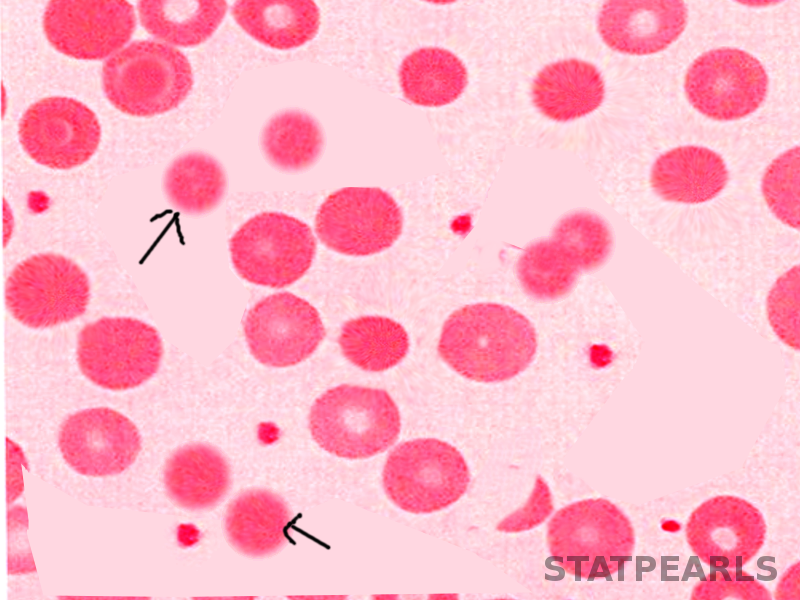 Hereditary Spherocytosis