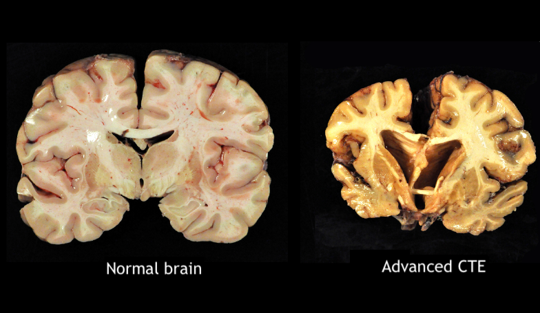 Brain dissections of normal brain (Left) and a brain with stage IV chronic traumatic encephalopathy(Right).