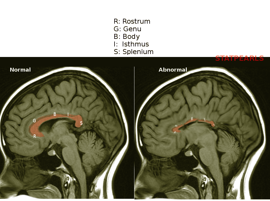 Corpus callosum hypoplasia