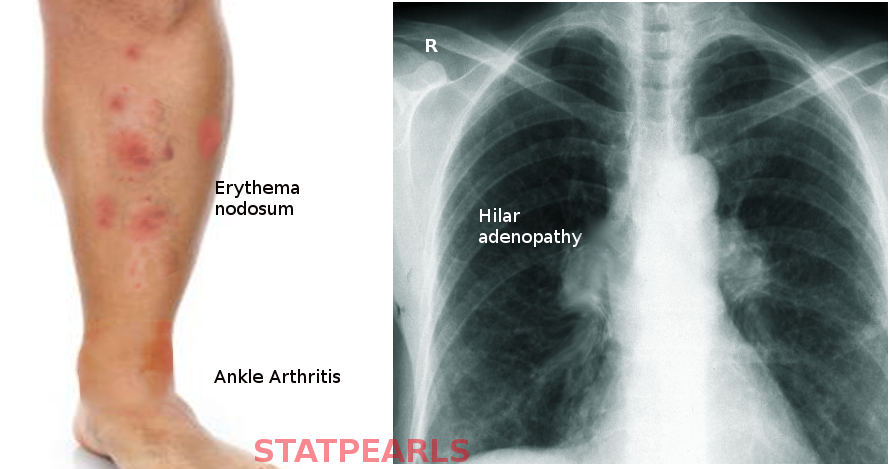 Lofgren syndrome