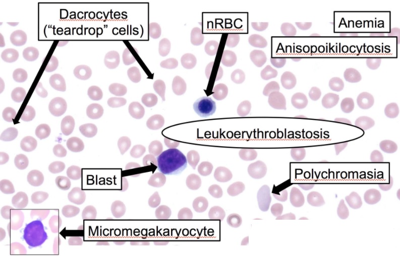 <p>Leukoerythroblastosis Reaction in the Peripheral Smear</p>