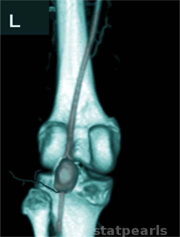 <p>Popliteal Artery Aneurysm Visualized on Magnetic Resonance Angiography