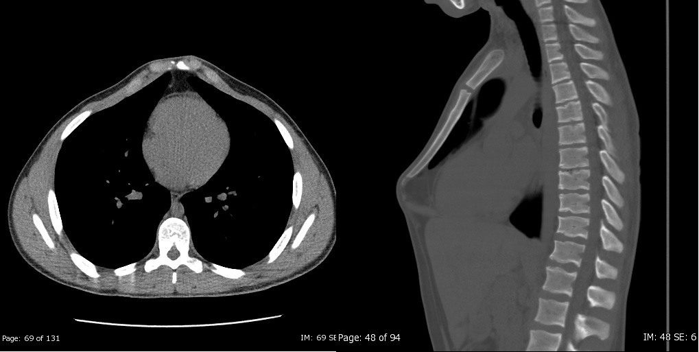 Pectus carinatum, 17 year old male