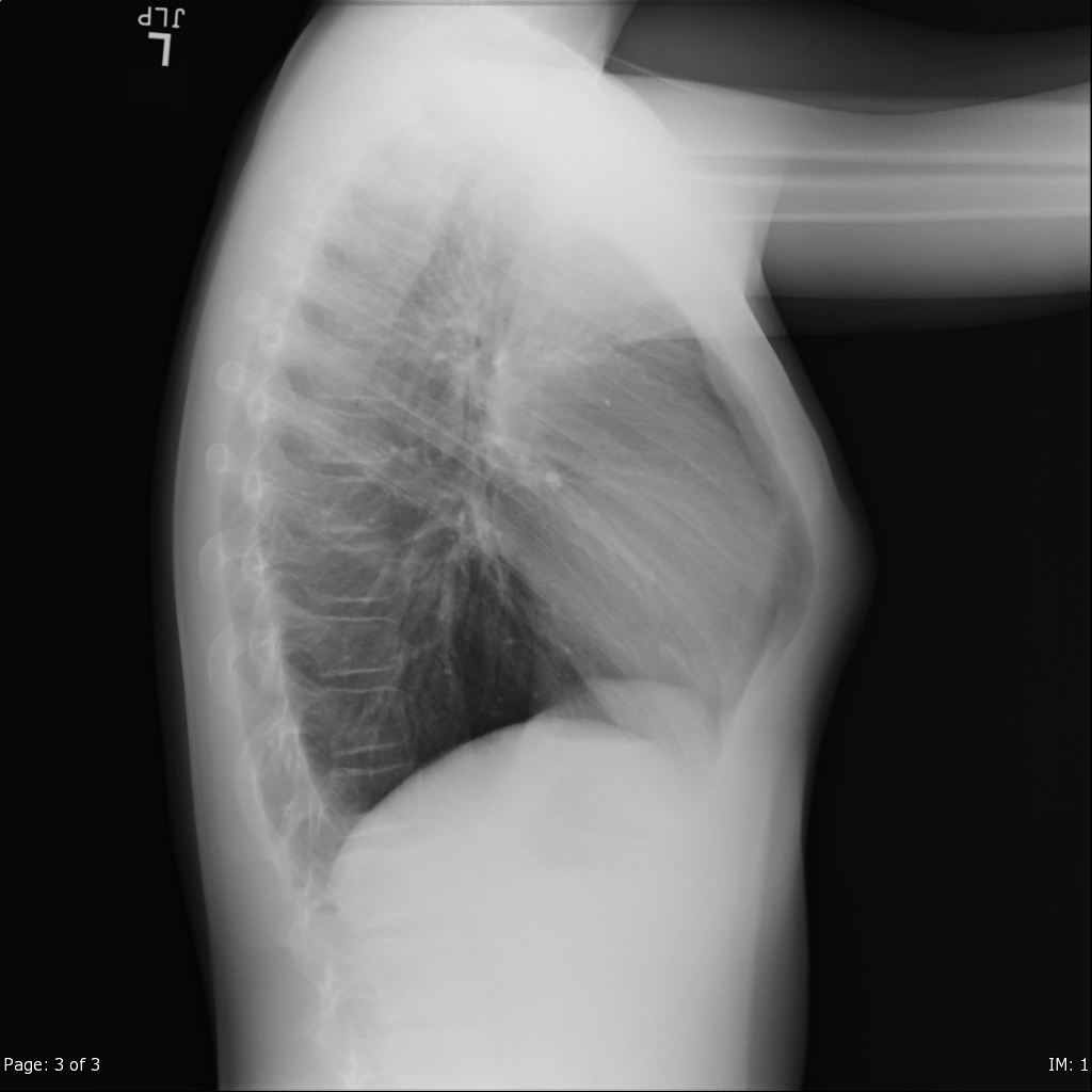 Pectus carinatum, 12 year old male