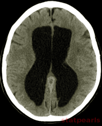 Normal pressure hydrocephalus