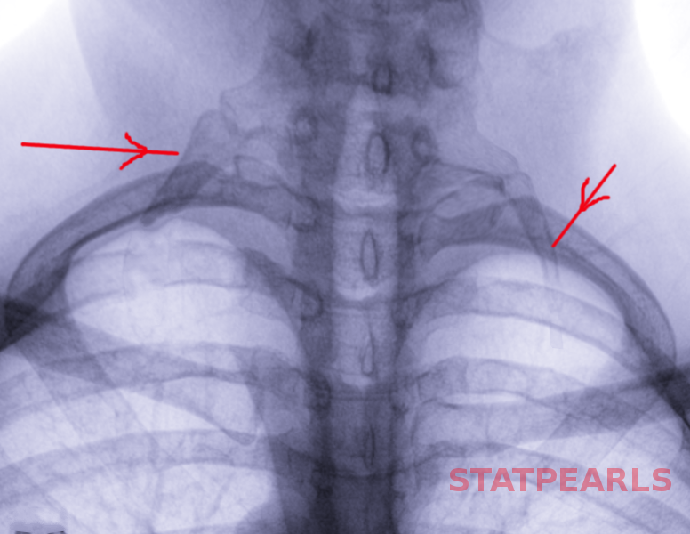 Cervical rib