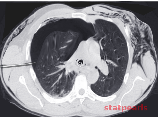 Subcutaneous emphysema