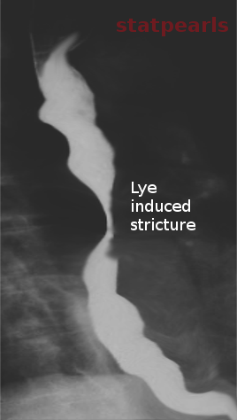 Esophageal stricture